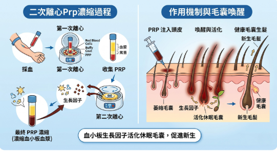 二次離心 PRP 生髮三階段理論與國際醫學實證
