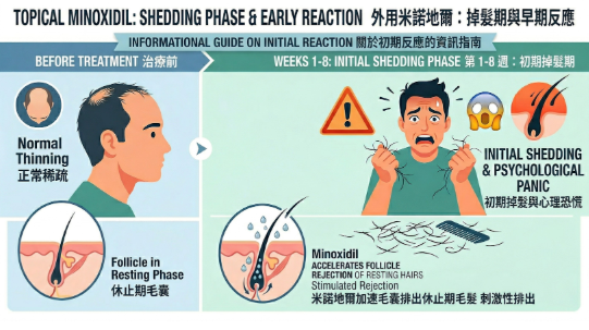外用生髮水 Minoxidil 頭皮刺激與換毛期