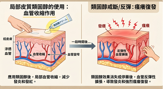 夏天【濕疹】大爆發怎麼救？別人流汗是陽光，我流汗是災難！