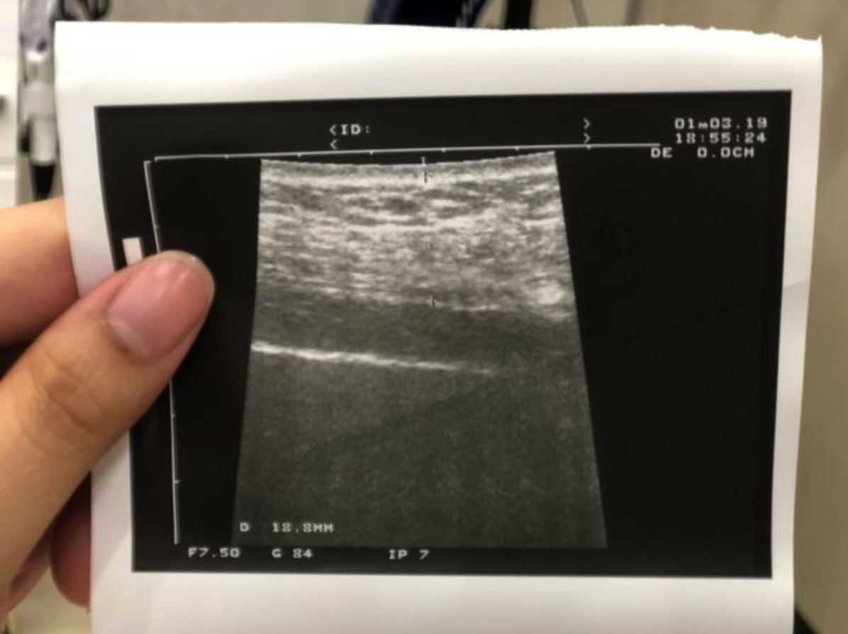 腹部脂肪厚度超音波檢測照片