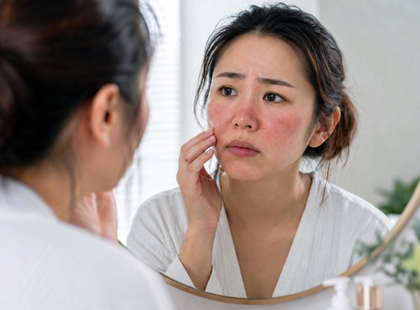 【酒糟肌】反覆泛紅、刺癢、灼熱怎麼辦？患者必看的修復策略
