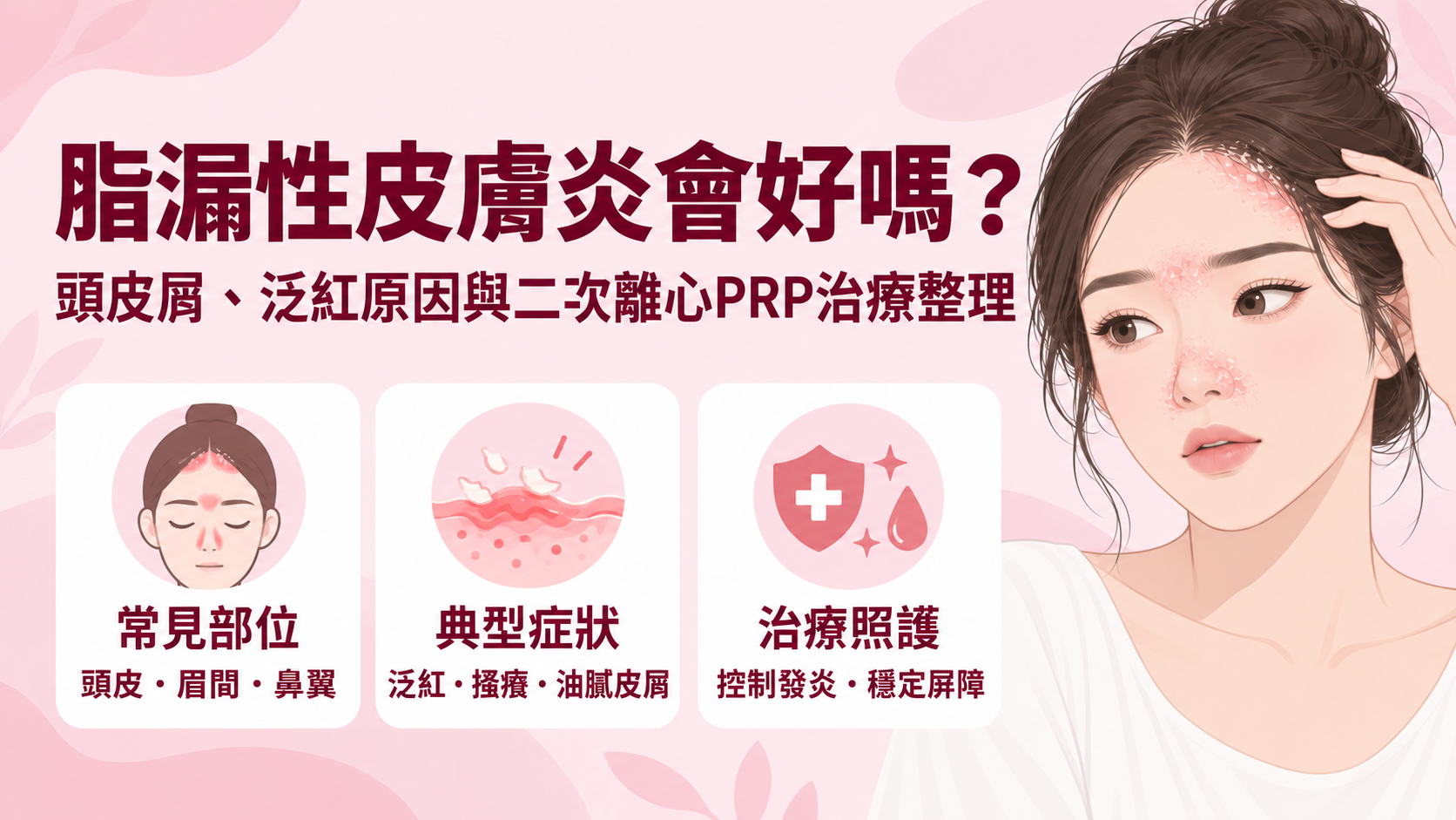 脂漏性皮膚炎會好嗎?頭皮屑、泛紅原因與二次離心PRP治療整理